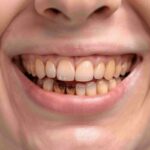 Les causes des dents jaunes : tabac, café et alimentation en tête des responsables