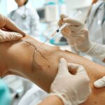 Sclérothérapie pour varices : traitement efficace, indications et déroulement de la procédure