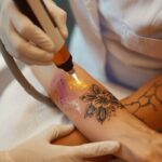 Le tatouage n'est plus irréversible : l'essor du détatouage et ses enjeux